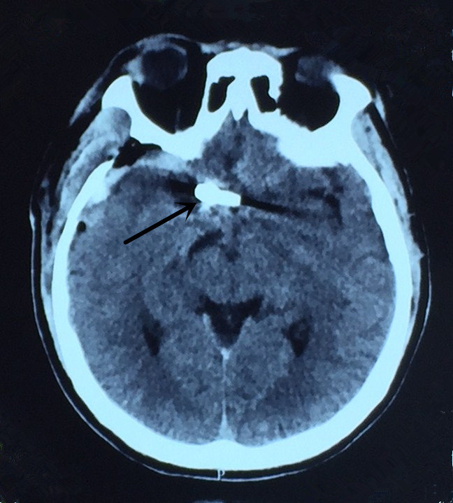 手术切除类垂体瘤表现动脉瘤一例