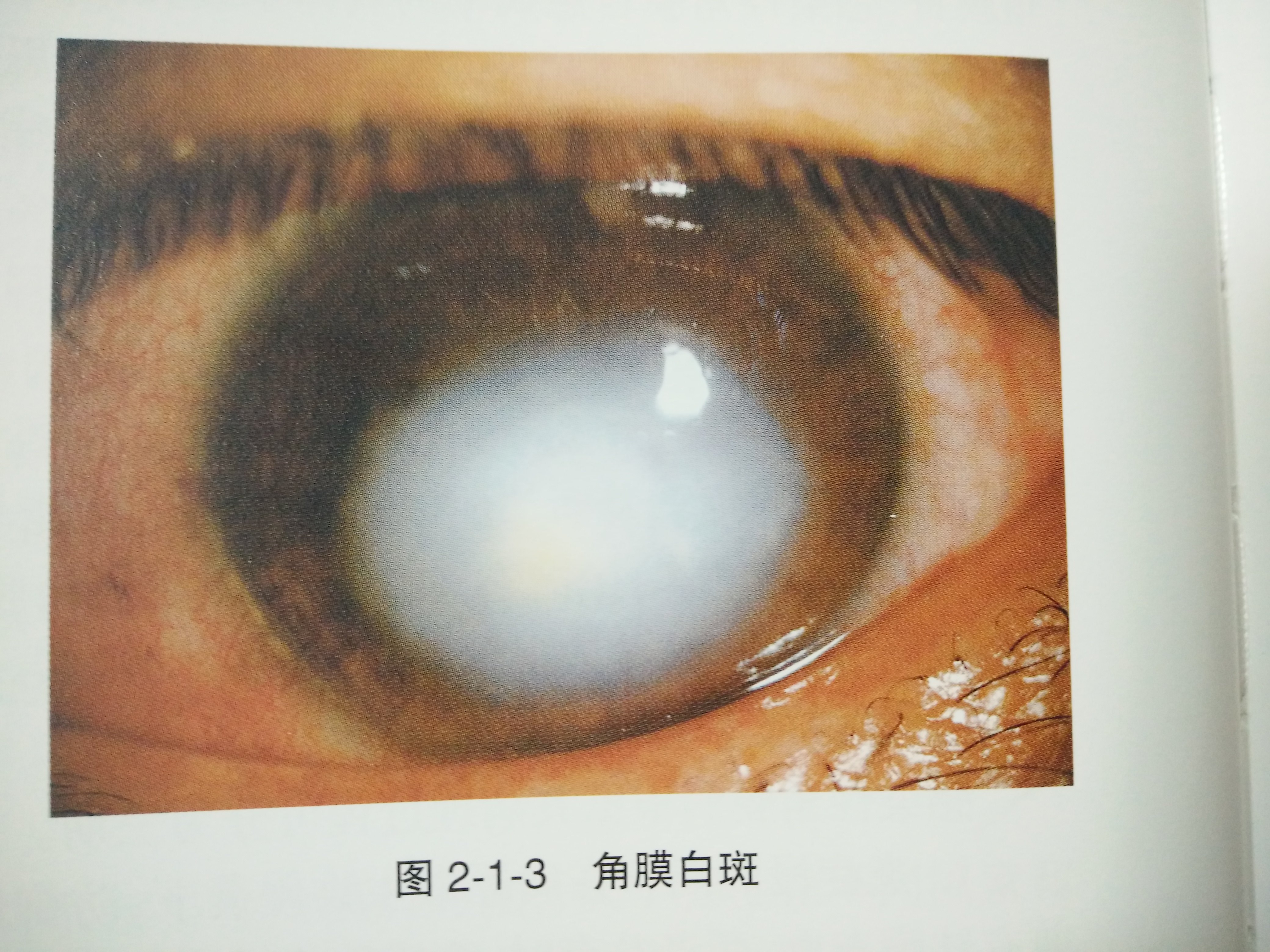角膜白斑染色图片