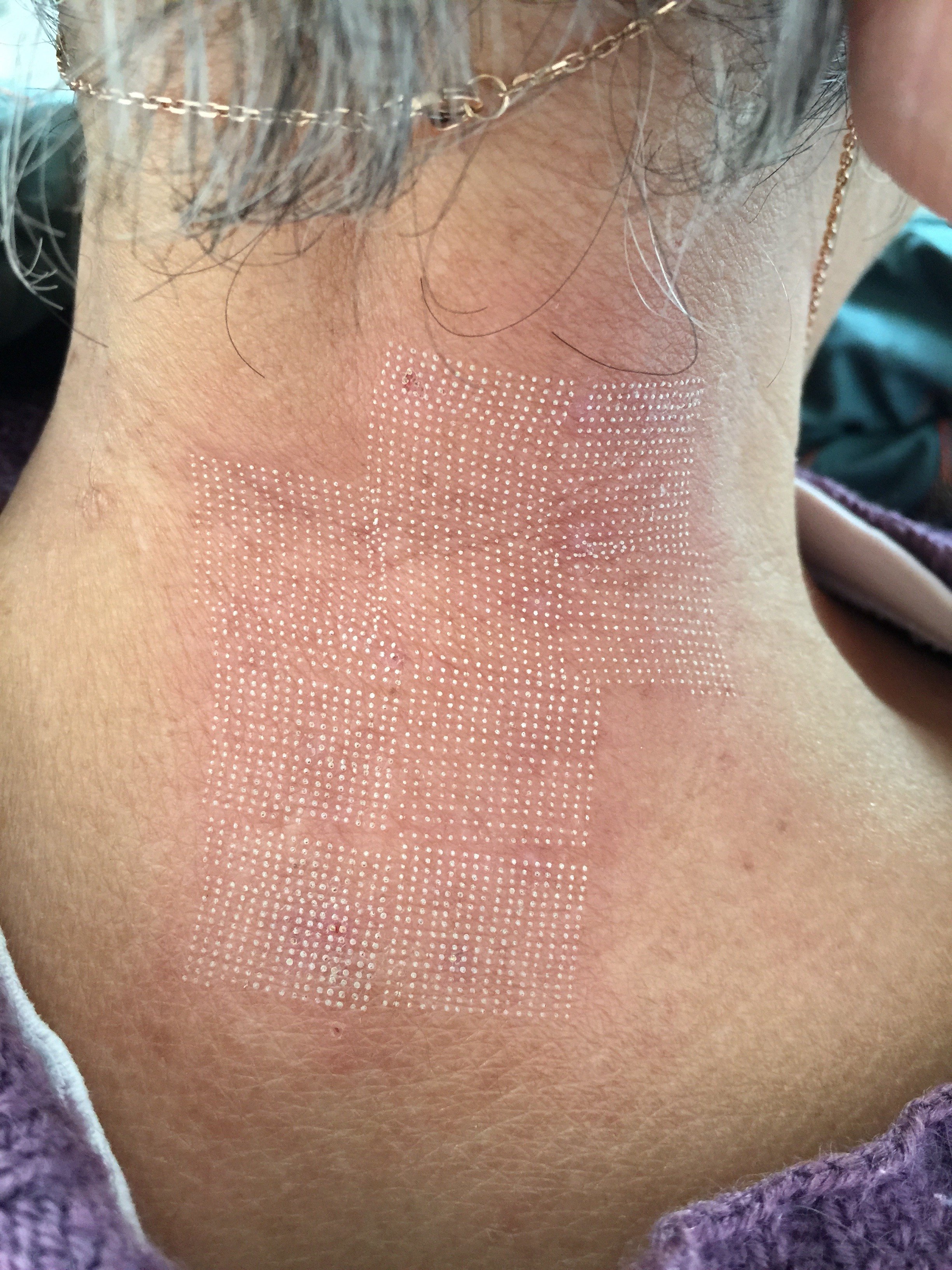 co2点阵激光,有效治疗"牛皮癣"