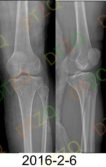 陈旧胫腓骨骨折治疗1例