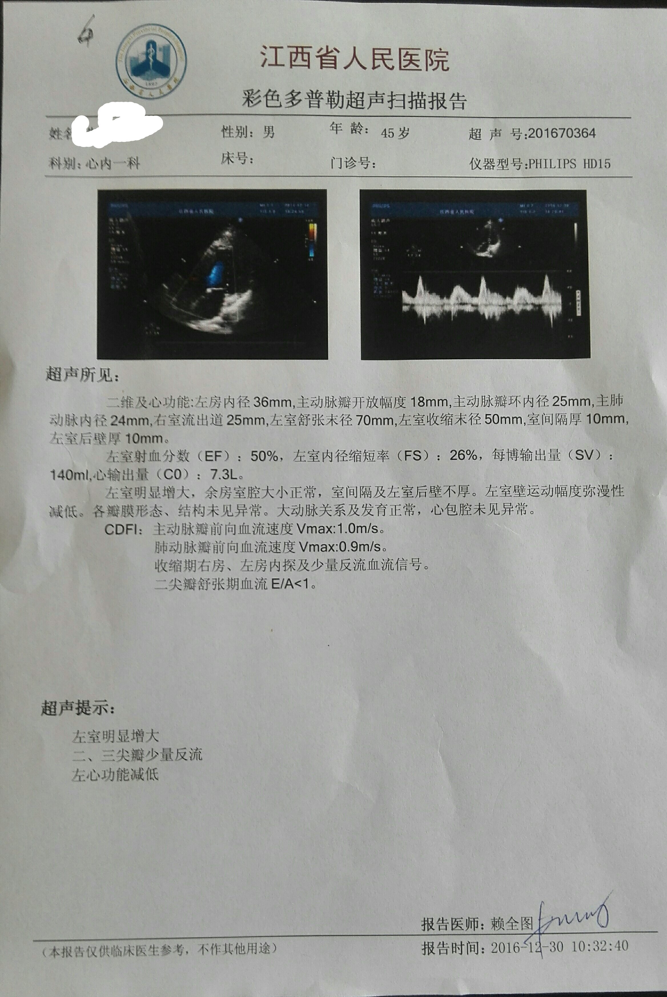 扩张型心肌病彩超图片