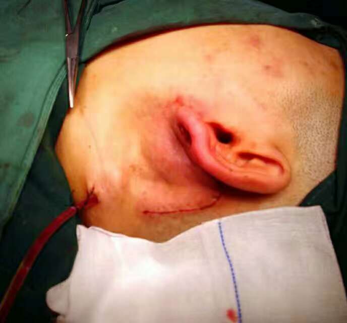 腮腺囊肿手术过程图图片