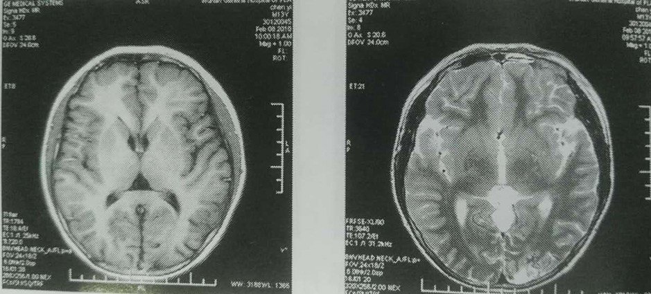 头部伽马刀治疗脑血管畸形病例分享2