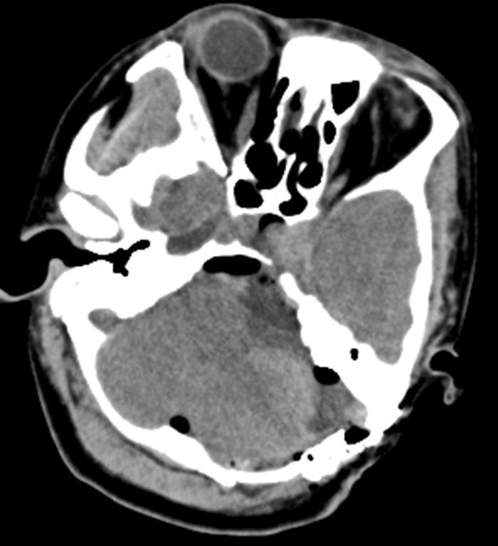听神经瘤-肿瘤医院神经外科