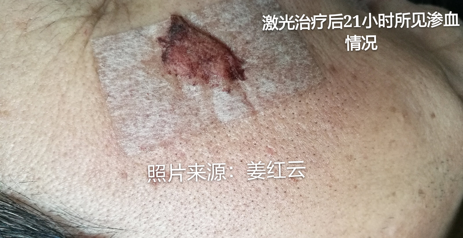 激光治疗后可以喝酒吗? - 好大夫在线