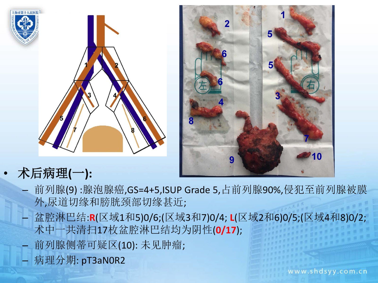 擴大盆腔淋巴結清掃在前列腺癌根治術中的應用:病例分享