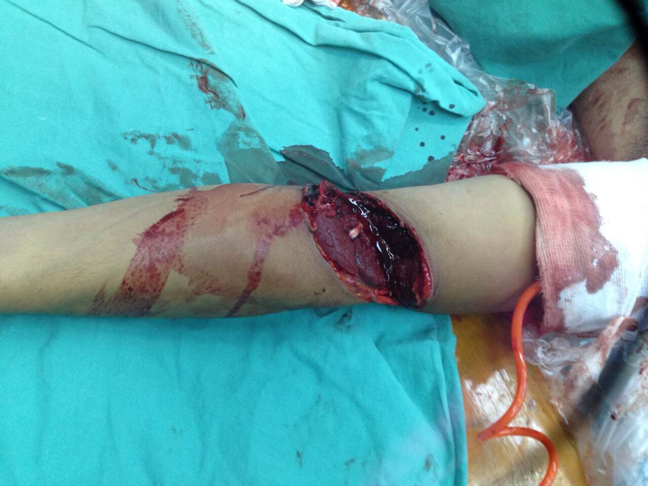 今天不全断臂再植手术功能再回访,功能恢复好,回顾 - 好大夫在线