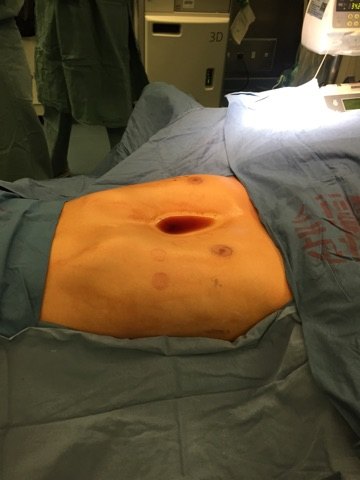 手术后照片小结:微创外科治疗(nuss术)已经成为漏斗胸治疗的首选,创伤