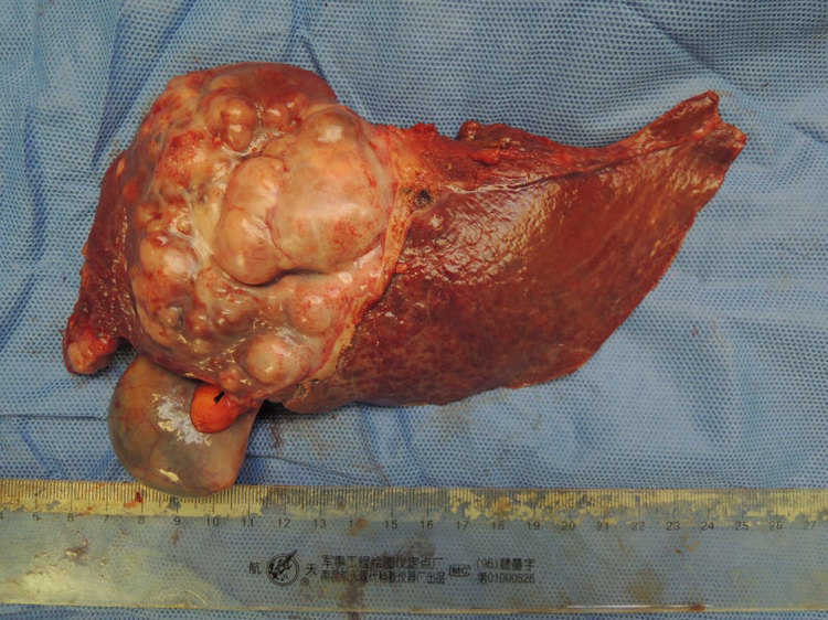 左肝癌合并门静脉癌栓 - 好大夫在线