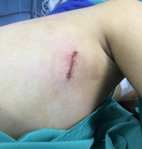 单孔胸腔镜在肺癌中的应用_肺癌_手术_- 好大夫在线