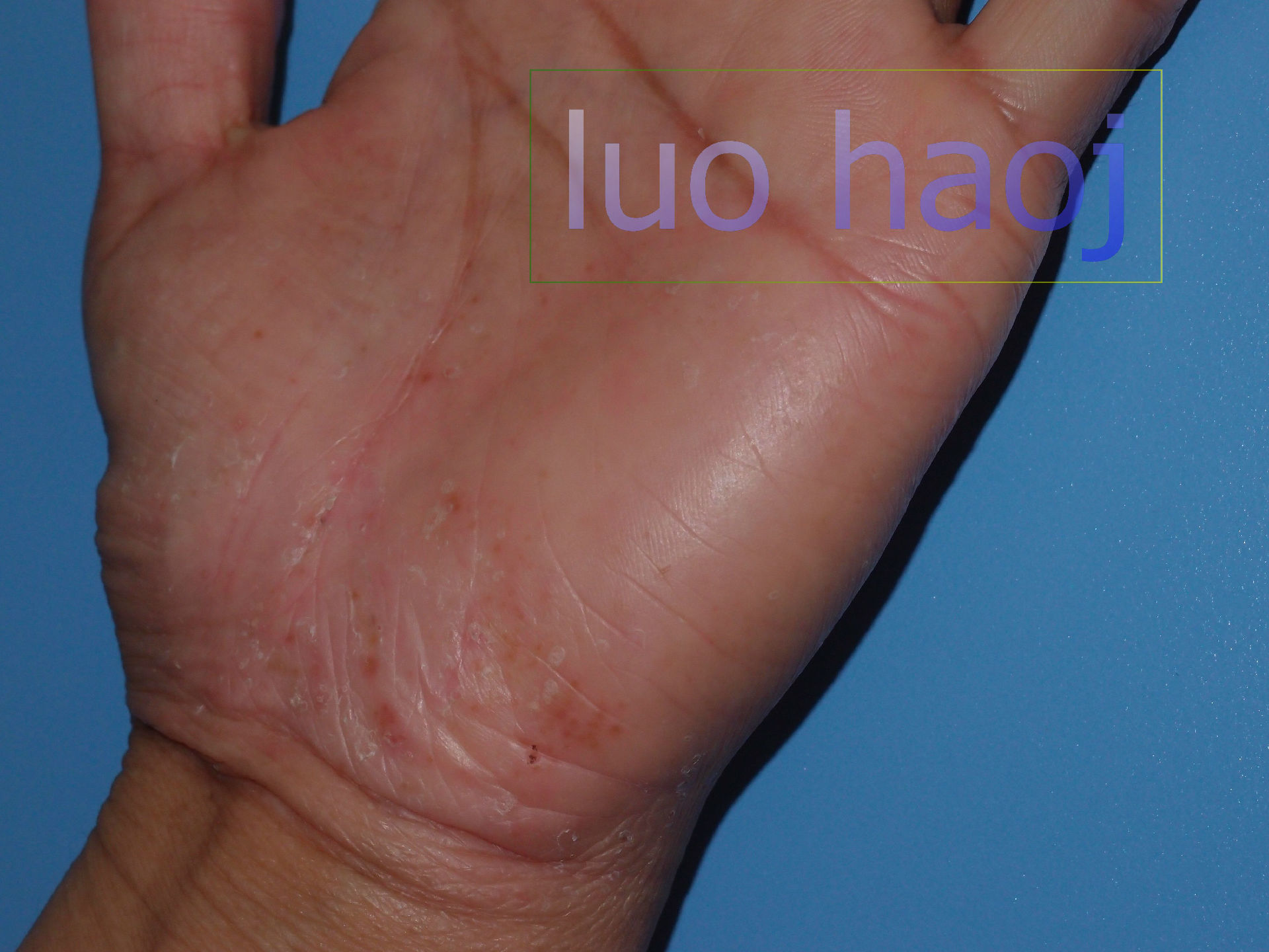 掌跖脓疱病治疗实例