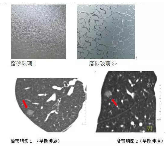 毛玻璃结节图片