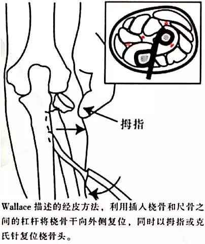 兒童橈骨頸頭骨折分型與治療