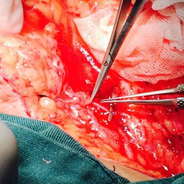 淋巴水肿的手术选择 - 好大夫在线