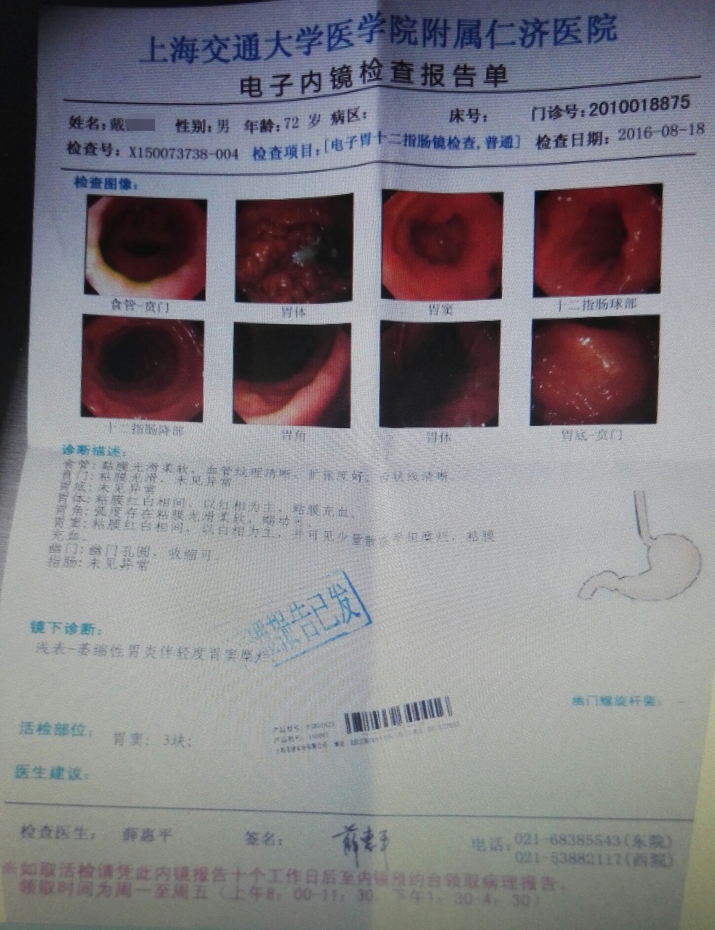 一例中度萎缩和肠化,伴异型增生的胃炎患者的治愈经过 