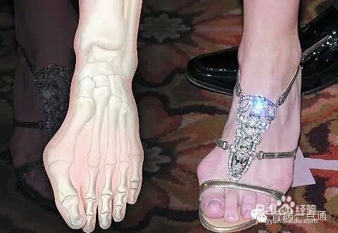 高跟鞋与拇外翻的"畸恋"