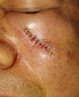 基底细胞癌的手术治疗 - 好大夫在线