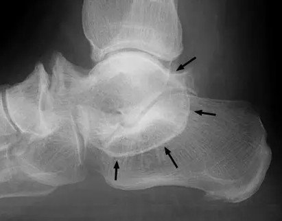 跟距骨桥的微创治疗(关节镜下切除术)