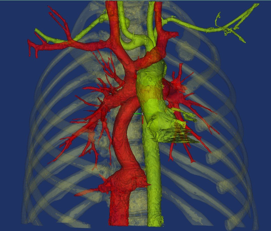 复杂先天性心脏病功能性单心室也可以用微创手