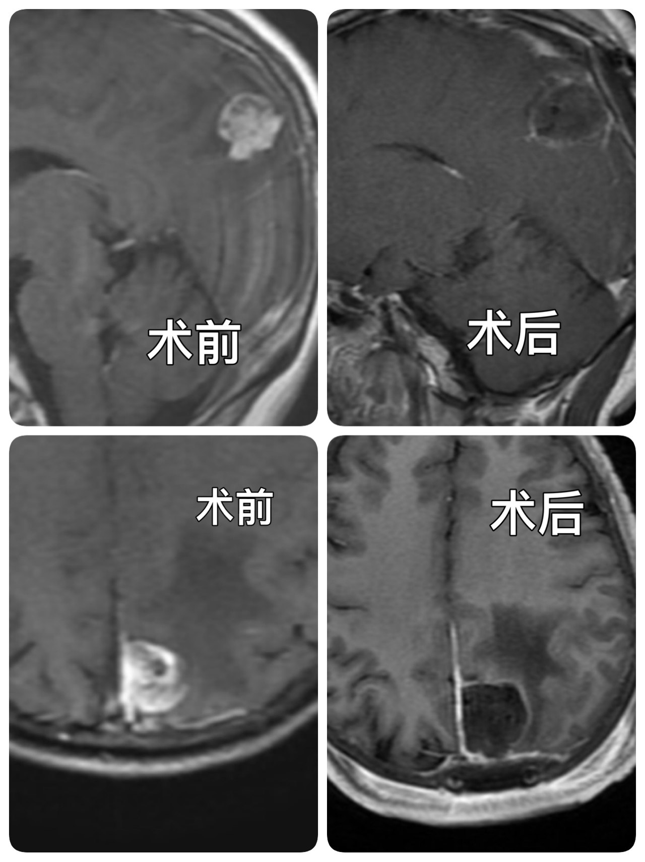 弧形剪開硬膜,沿大腦鐮分離.探查見