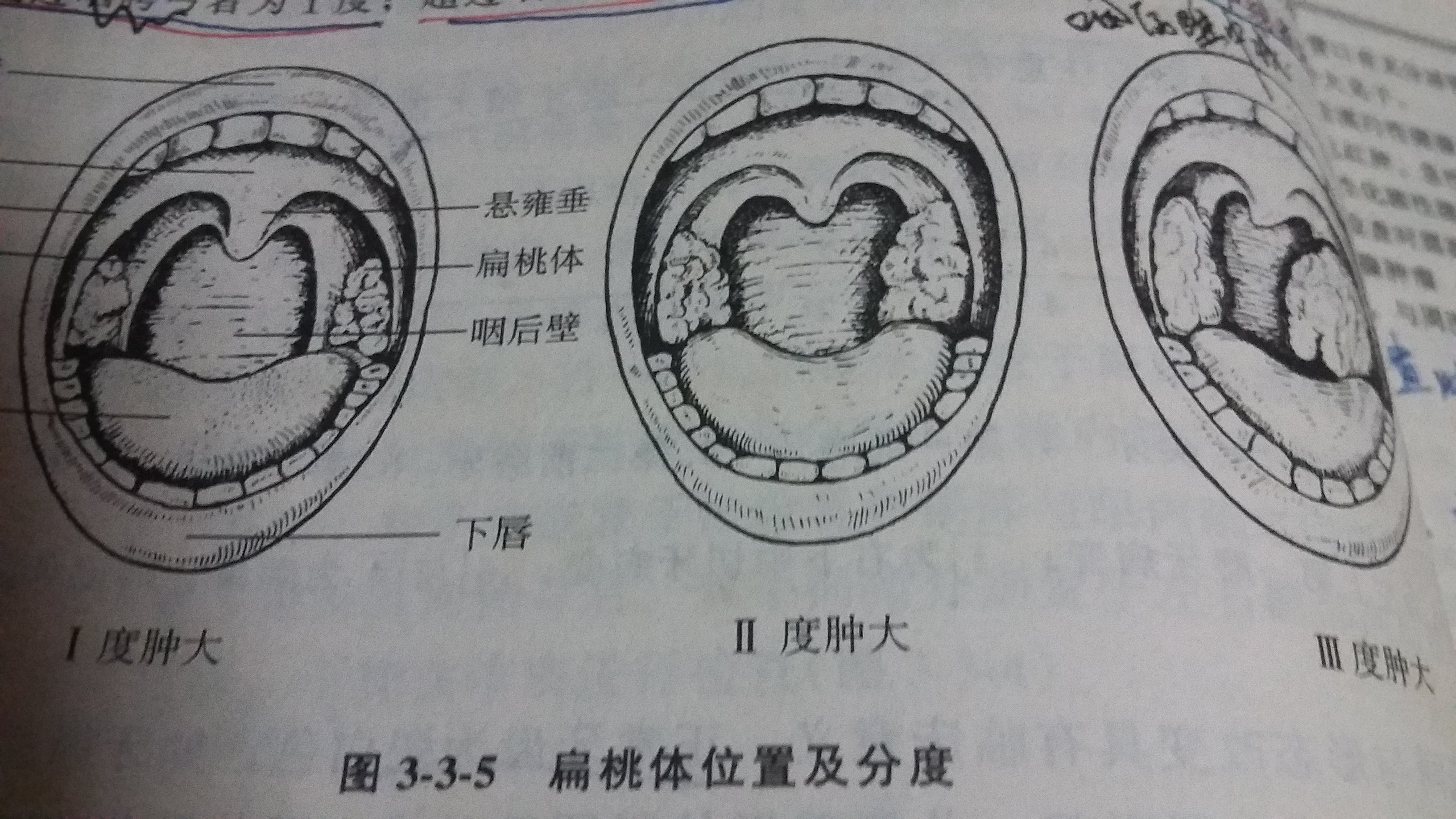 咽腭弓正常的图片图片