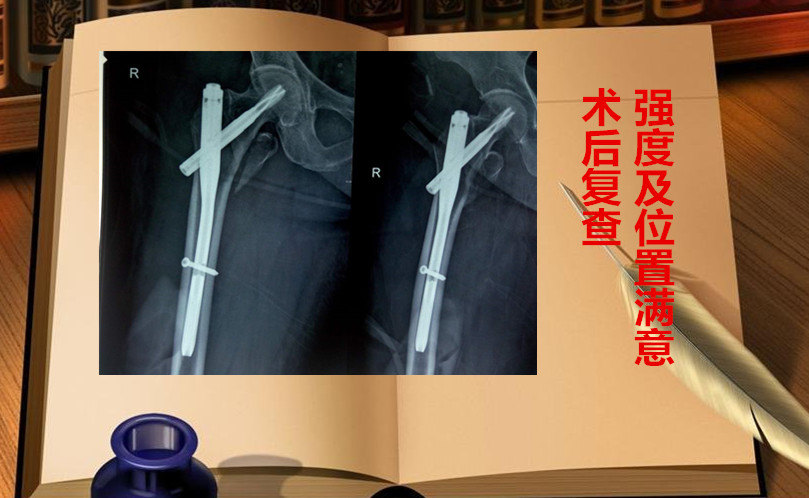 圖解股骨粗隆間骨折pfna內固定治療