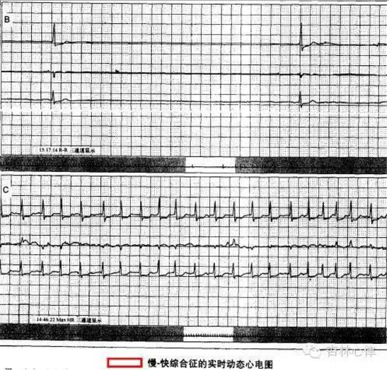 各异的帮派老大——谈谈病窦综合征分型