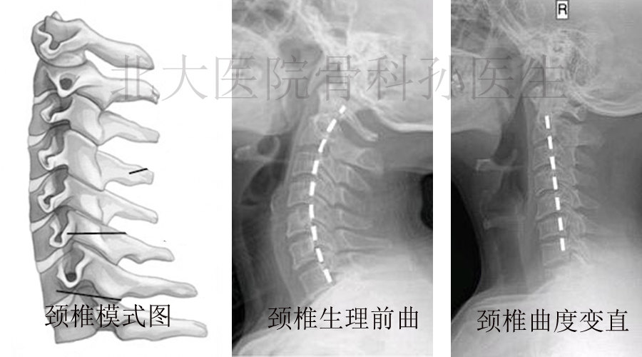 颈椎病患者的自我救赎 运动篇 颈椎病 疾病介绍 病因 饮食运动 症状