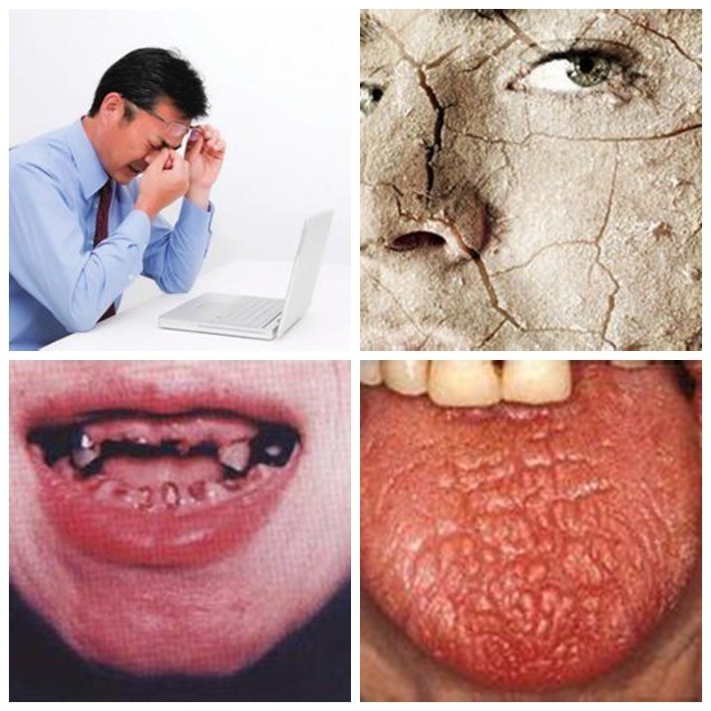 干燥综合征患者家居生活指南 - 好大夫在线