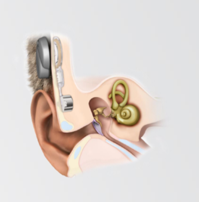 骨桥助听器植入图片