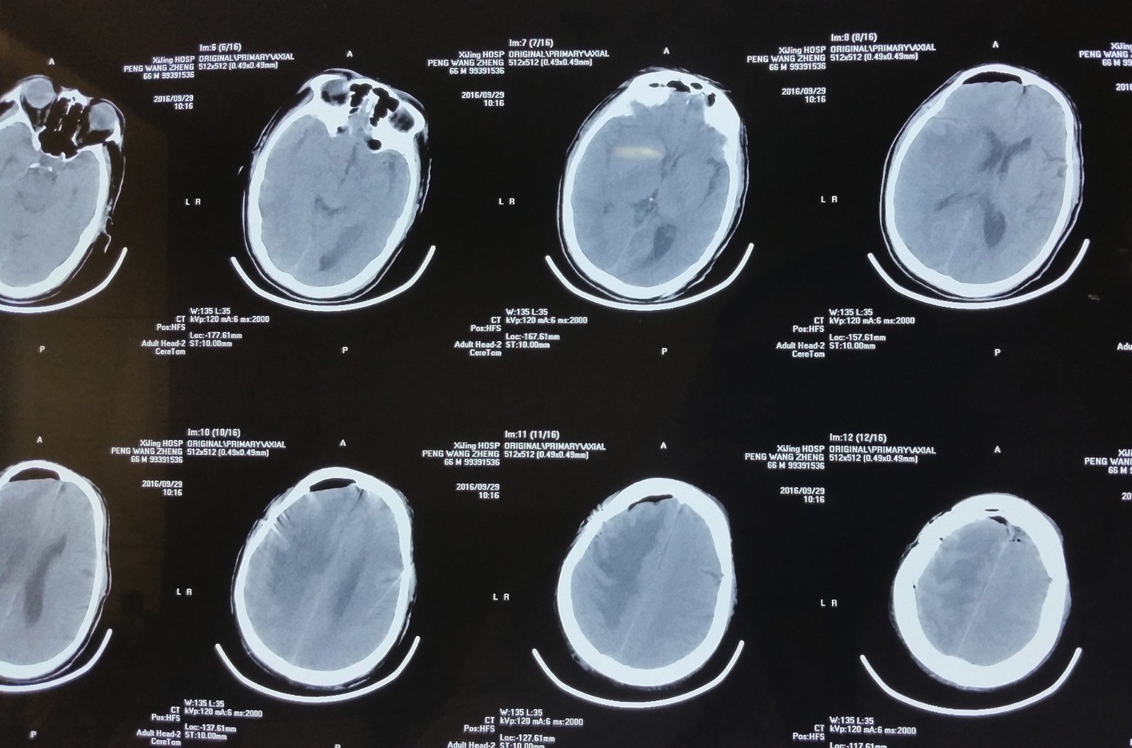 術後病理:腦膜瘤出院情況:良好,四質 無癱瘓,行走正常.