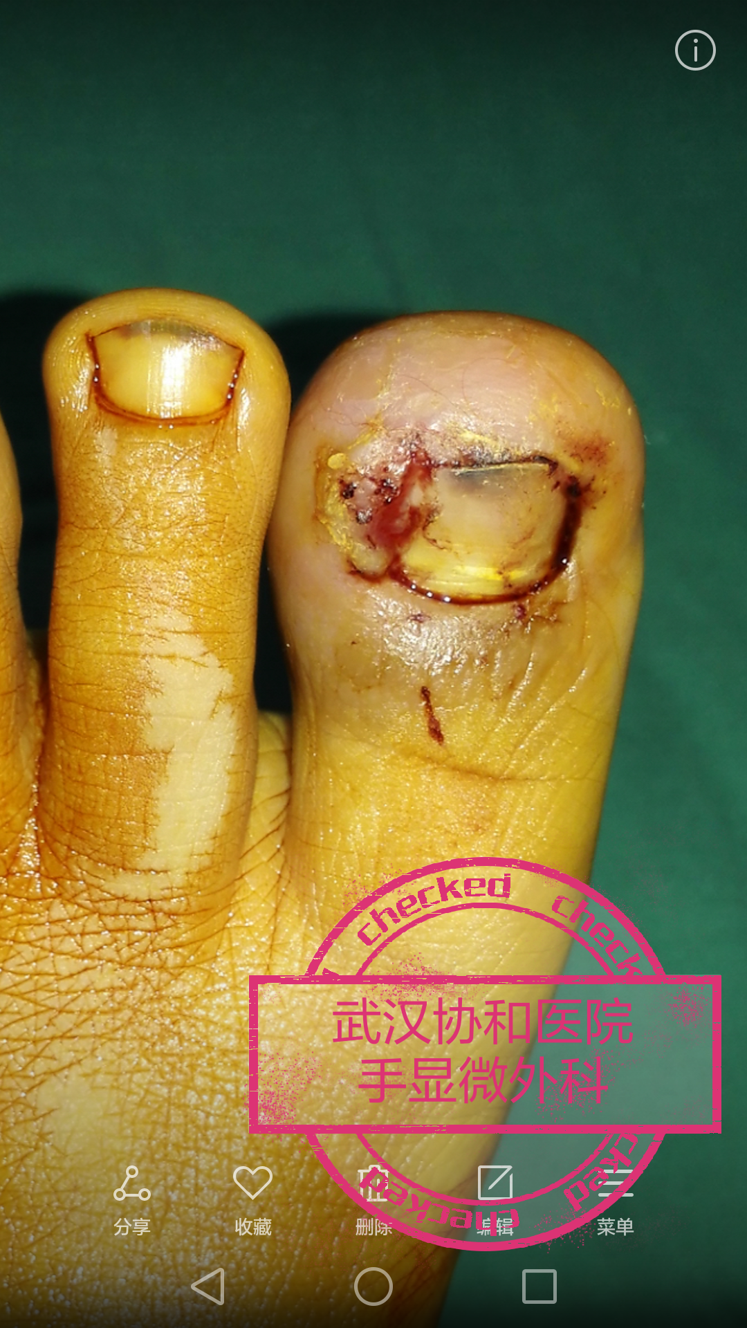 嵌甲性甲沟炎的保守及手术治疗_甲沟炎_疾病介绍_治疗方法_介绍_治疗