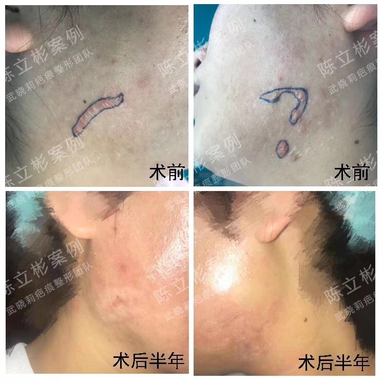 下颌疤痕疙瘩术后半年随访 - 好大夫在线