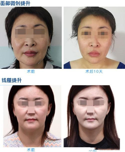 一般多少岁会长法令纹 uYYBAF2vv7GADRRNAAC_wzZV6Fs289.jpg?_ms_=3930