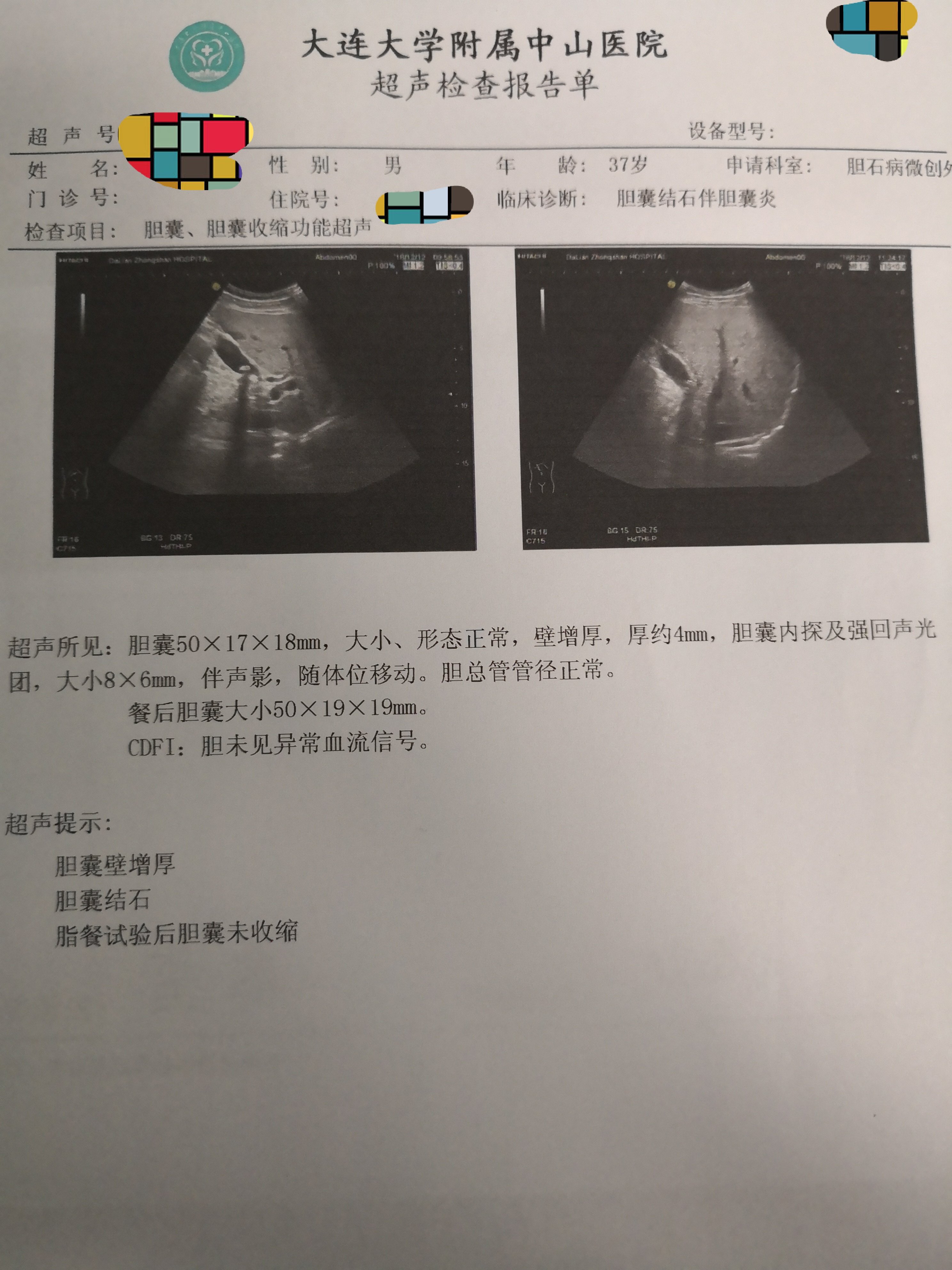 胆囊结石何时手术?