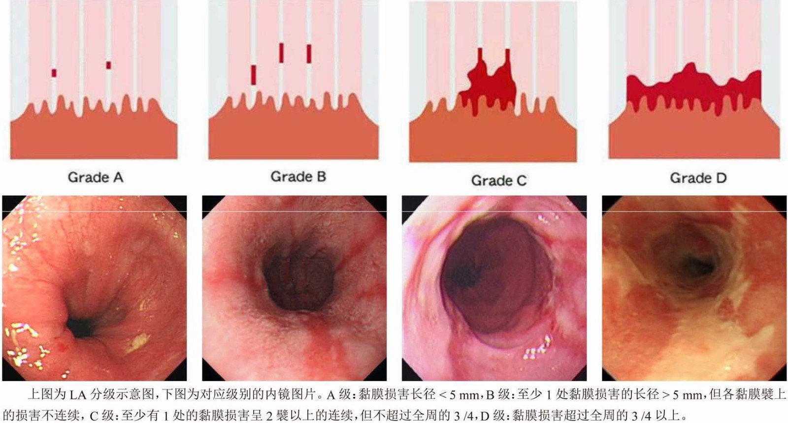 胃食管反流病内镜诊断标准及图片解读_刘思德.jpg
