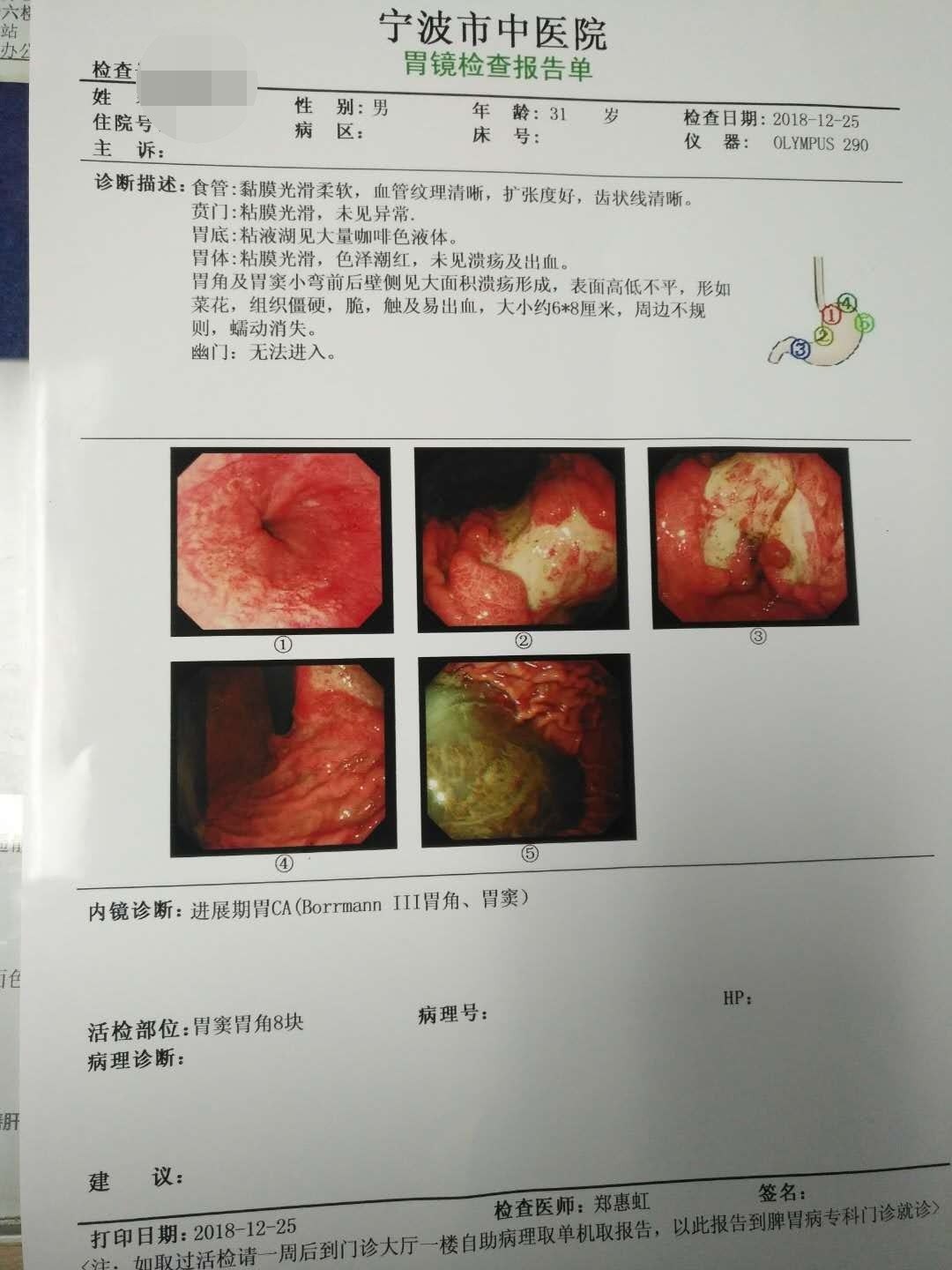 一例年轻晚期胃癌和一例年轻晚期大肠癌引发的思考 - 好大夫在线