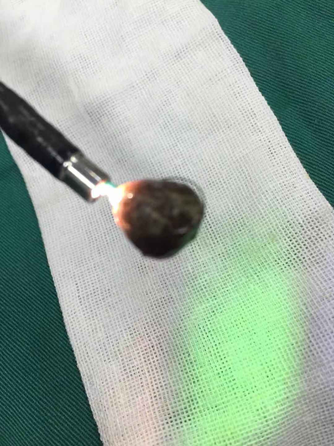 胆总管结石手术治疗三种方法 - 好大夫在线