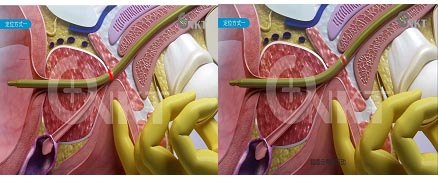 「前列腺增生」患者的福音:小小水囊显神威