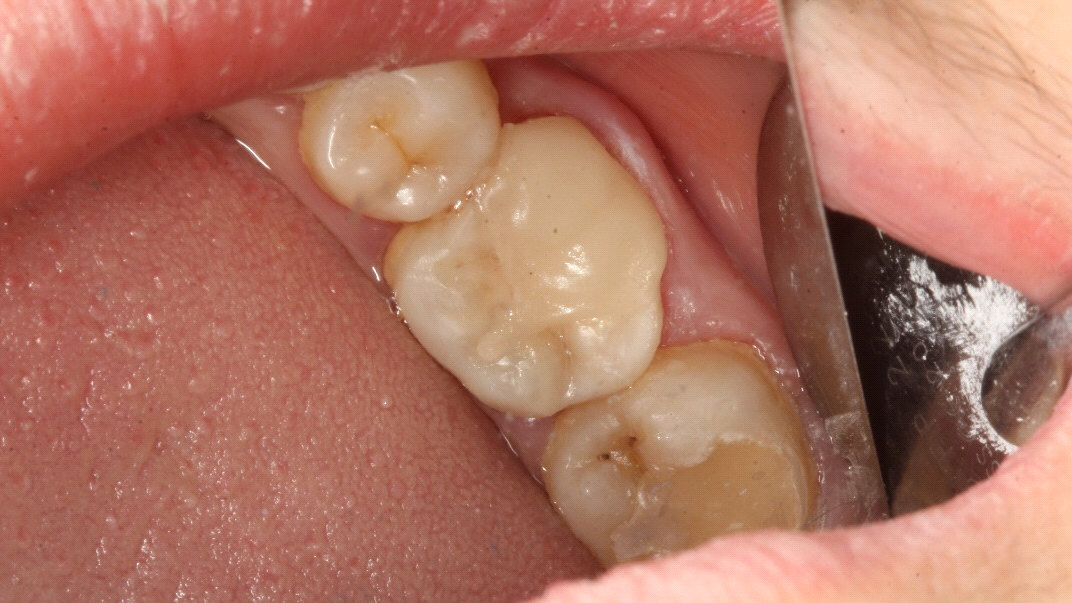 我是如何处理食物嵌塞