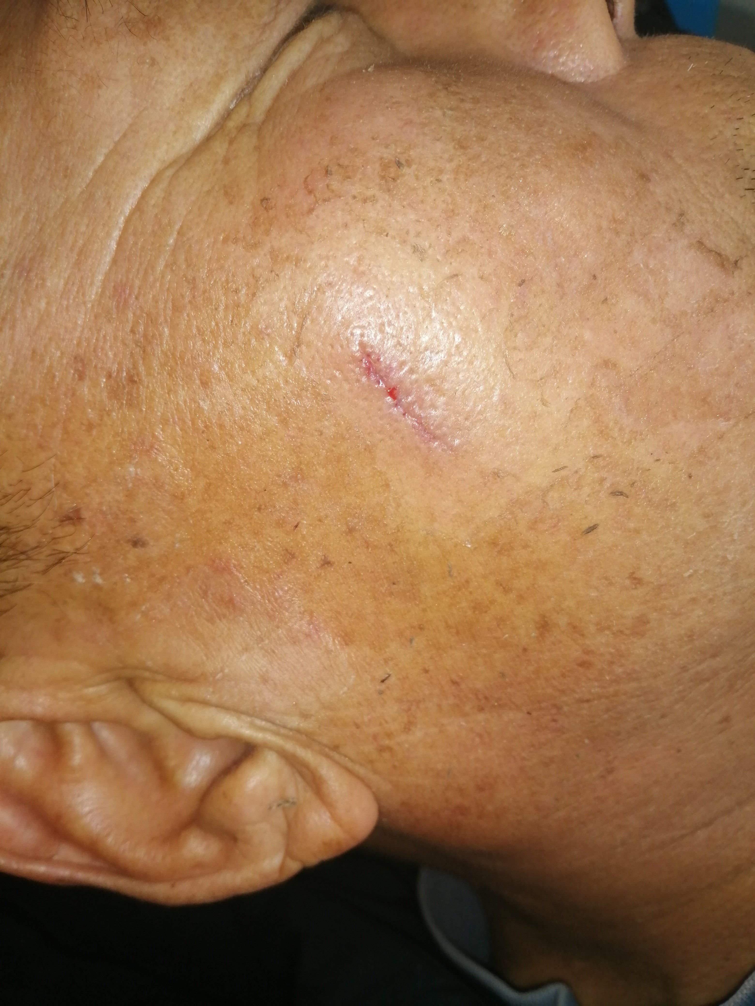 额头脂肪瘤手术疤图片图片