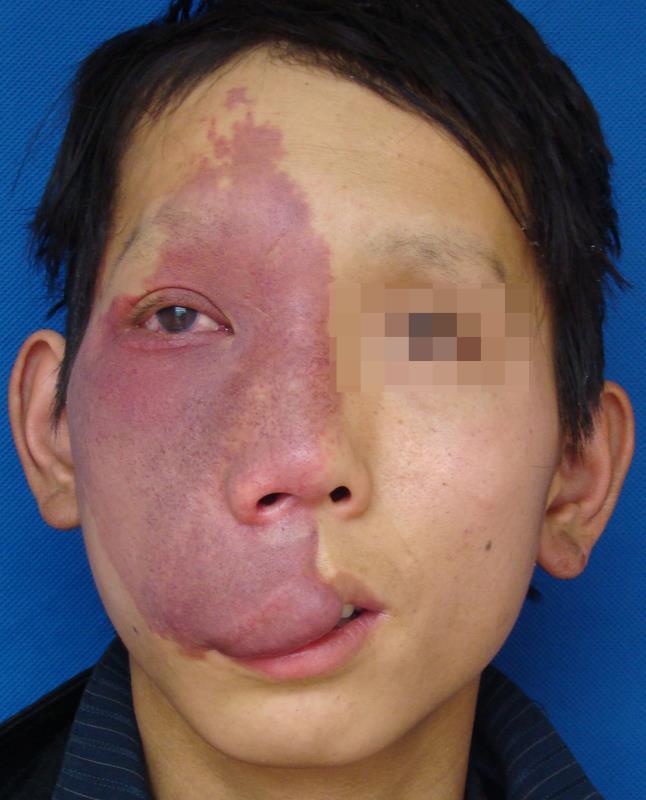 济南血管瘤医院:打造专业治疗与温馨服务并重的医疗典范