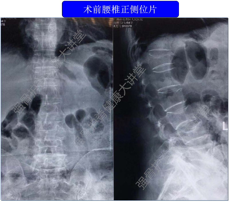 脊柱骨折活動難成形術後復健行