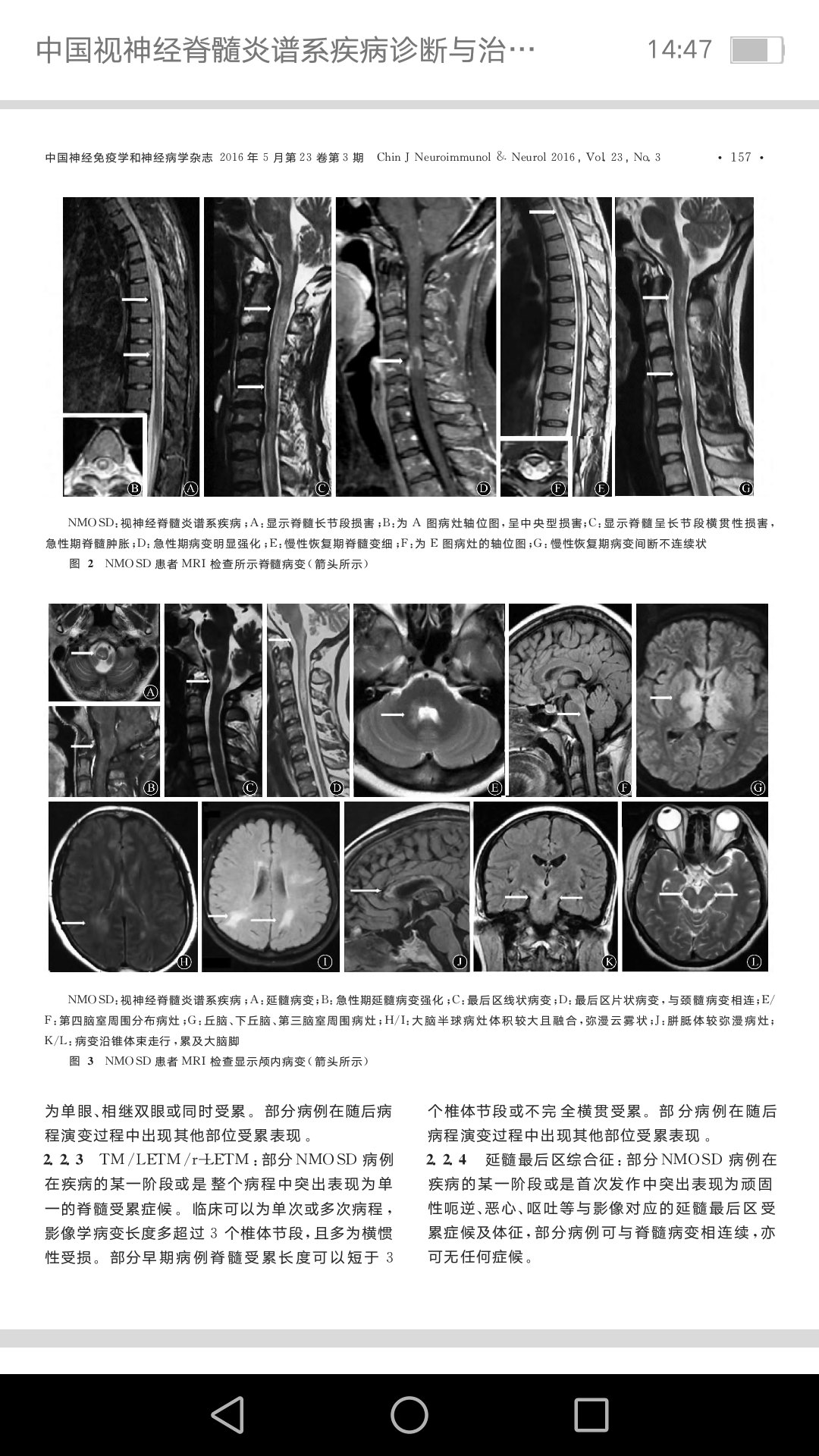 神经脊髓炎谱系疾病(nmosd)目前西医诊疗指南比较明确,根据患者的症状