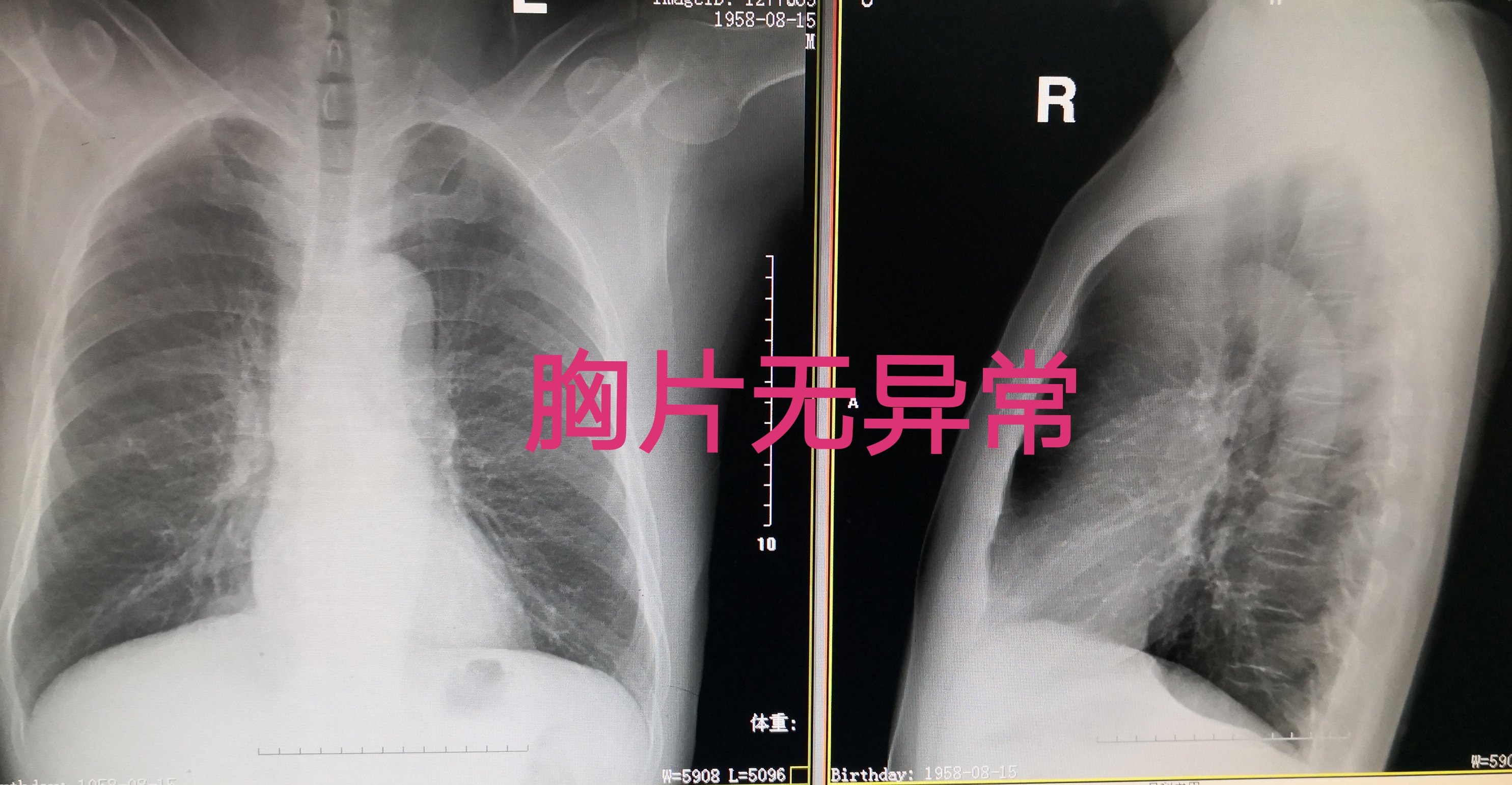 胸片檢查沒事為什麼卻診斷肺腫瘤