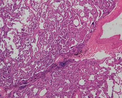 磨玻璃结节早期肺腺癌病理诊断中的问题与探讨 - 好大夫在线