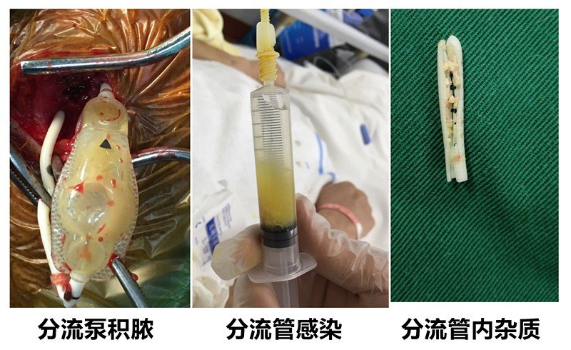 (4)脑脊液成分异常四,颅内感染(1)颅内耐药鲍曼不动杆菌感染(2)颅内