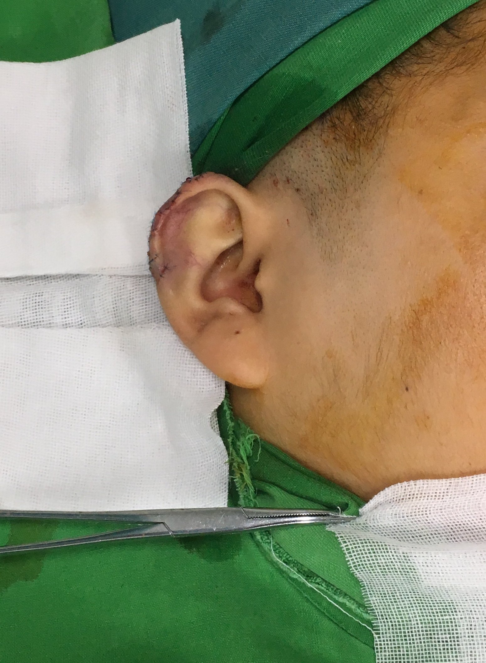 难治性双侧耳廓瘢痕疙瘩的手术治疗