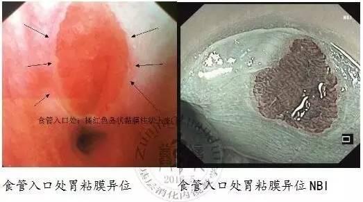 食管胃粘膜异位症图片