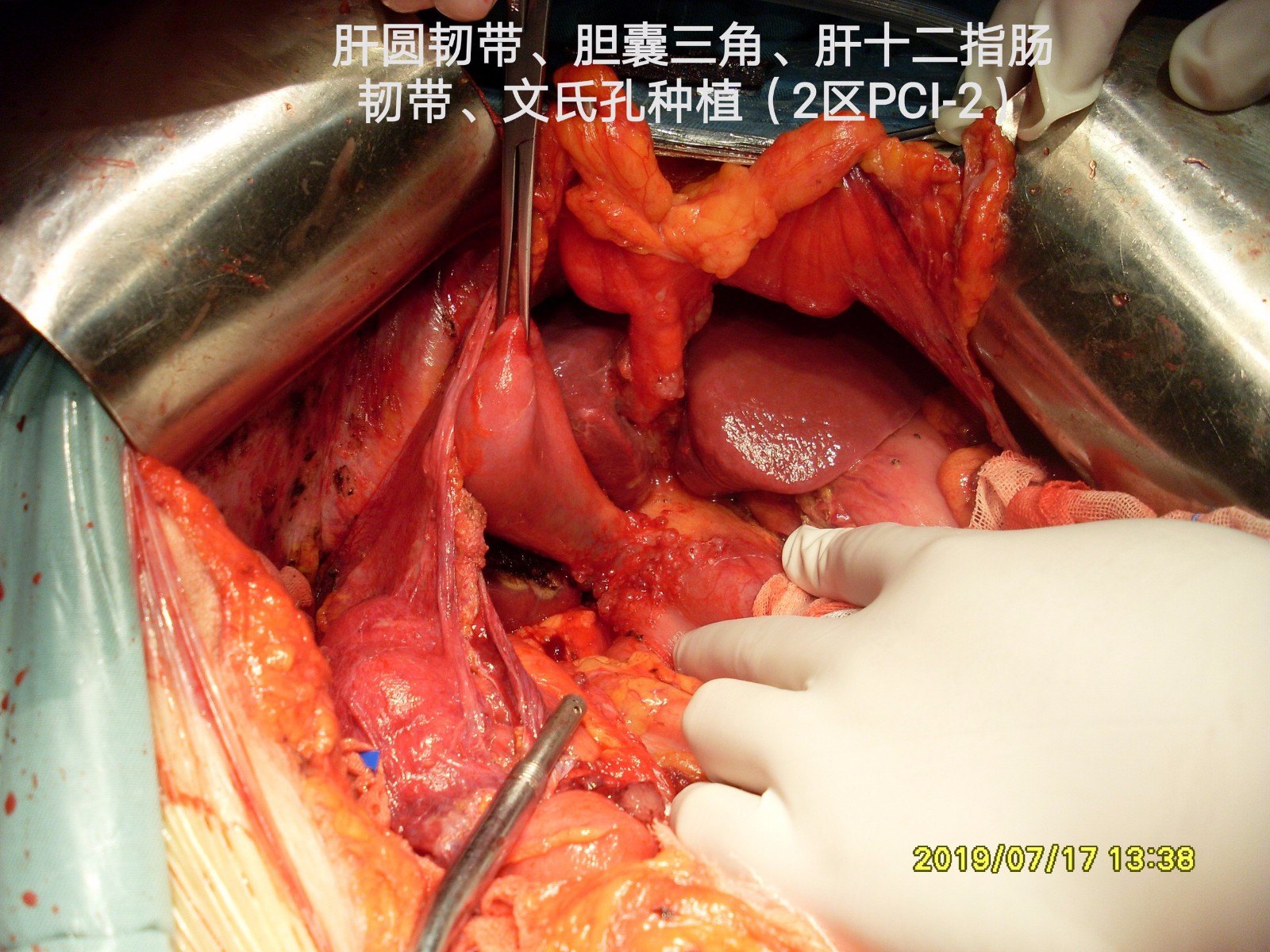 胆囊肝十二指肠韧带浆膜,肝圆韧带 肝桥,镰状韧带,双侧膈肌腹膜切除